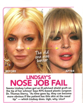 Illustration for article titled This Week In Tabloids: Lindsay Lohan's Nose Job Is Falling Apart